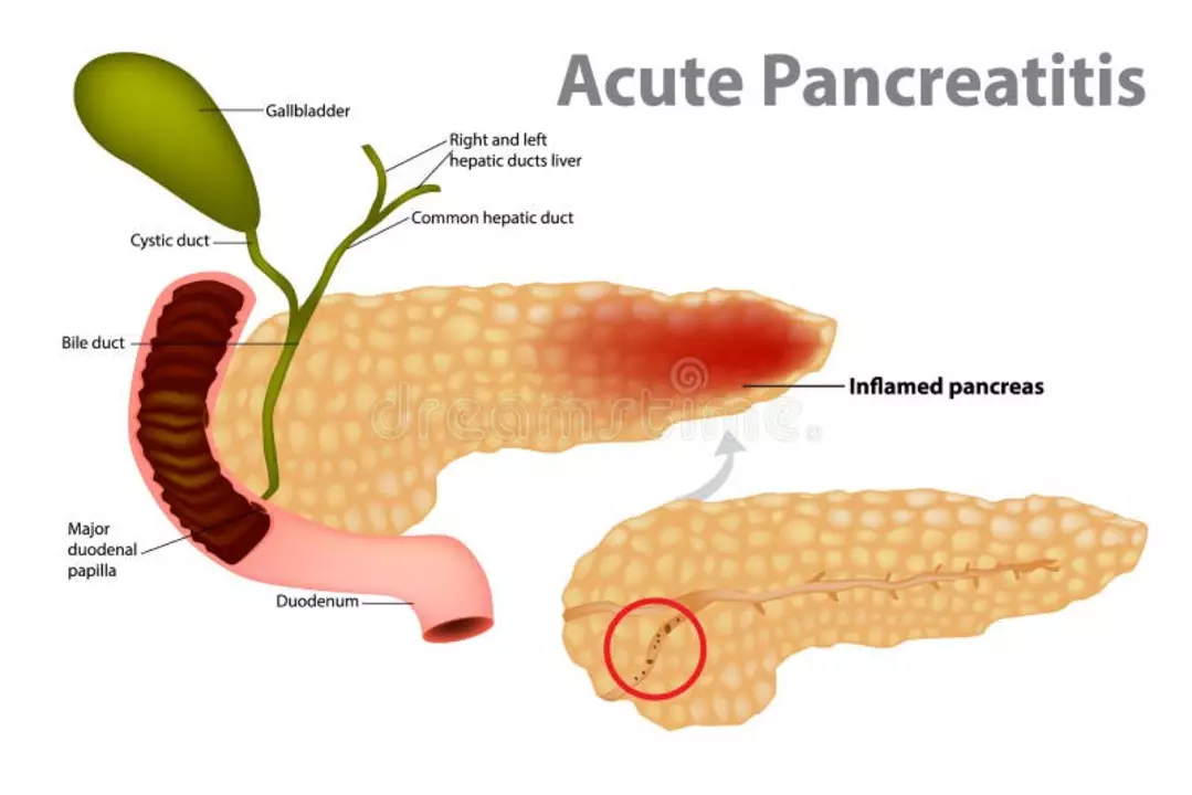 Gallstones and Pancreatitis: Understanding the Connection