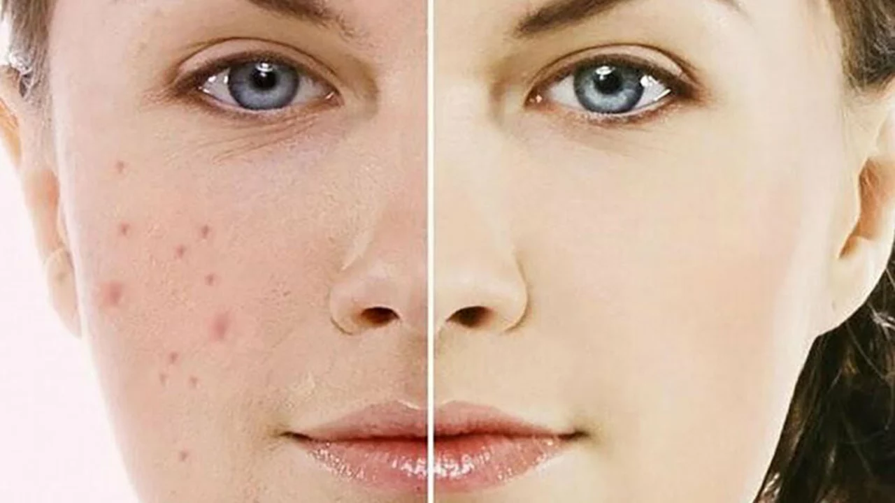 Minocycline vs. Doxycycline: Which is Better for Acne Treatment?